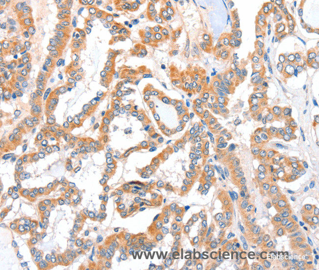 Immunohistochemistry of paraffin-embedded Human thyroid cancer tissue using ACSBG1 Polyclonal Antibody at dilution 1:40