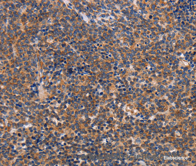 Immunohistochemistry of paraffin-embedded Human lymphoma tissue using ALG9 Polyclonal Antibody at dilution 1:30