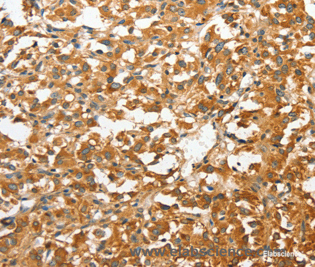 Immunohistochemistry of paraffin-embedded Human thyroid cancer tissue using ANXA9 Polyclonal Antibody at dilution 1:30