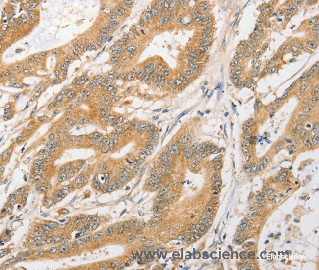 Immunohistochemistry of paraffin-embedded Human colon cancer tissue using ATG5 Polyclonal Antibody at dilution 1:40