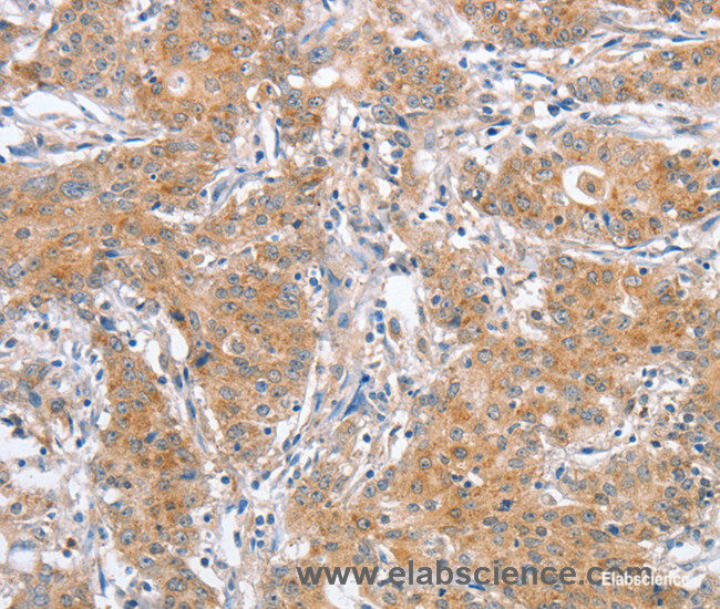 Immunohistochemistry of paraffin-embedded Human gasrtic cancer tissue using ATG12 Polyclonal Antibody at dilution 1:40