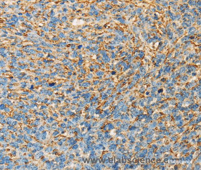 Immunohistochemistry of paraffin-embedded Human ovarian cancer tissue using APOA4 Polyclonal Antibody at dilution 1:30