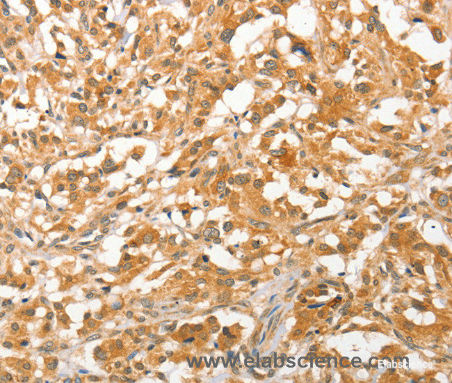 Immunohistochemistry of paraffin-embedded Human thyroid cancer tissue using APTX Polyclonal Antibody at dilution 1:50