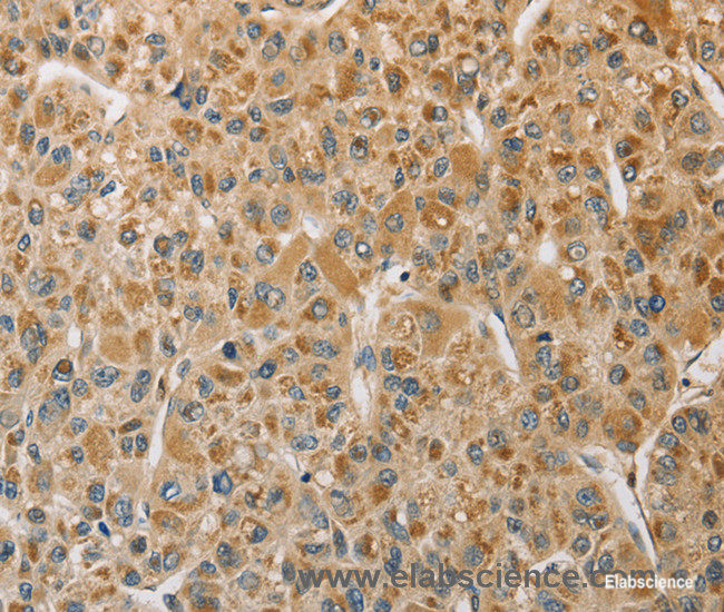 Immunohistochemistry of paraffin-embedded Human liver cancer tissue using MIP Polyclonal Antibody at dilution 1:50