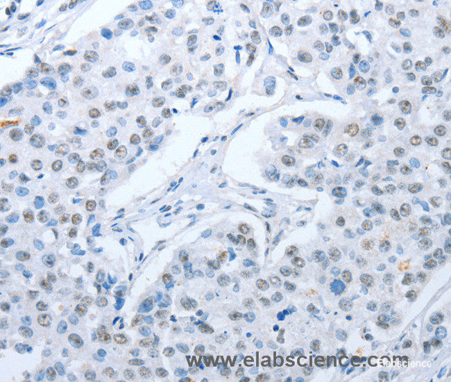 Immunohistochemistry of paraffin-embedded Human breast cancer tissue using ARHGEF2 Polyclonal Antibody at dilution 1:30