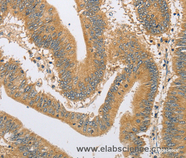 Immunohistochemistry of paraffin-embedded Human colon cancer tissue using ARHGEF1 Polyclonal Antibody at dilution 1:60