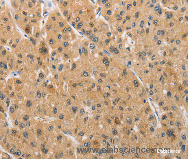 Immunohistochemistry of paraffin-embedded Human liver cancer tissue using ARMCX1 Polyclonal Antibody at dilution 1:40