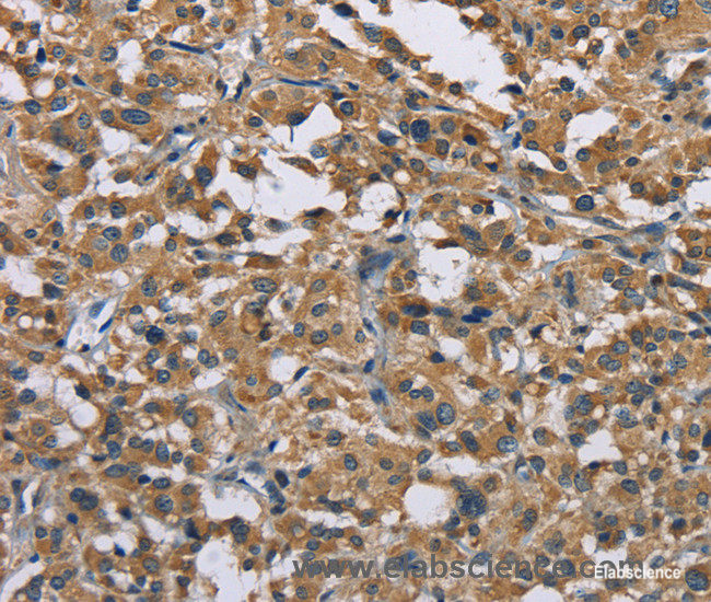 Immunohistochemistry of paraffin-embedded Human thyroid cancer tissue using GAB1 Polyclonal Antibody at dilution 1:40