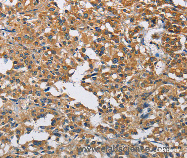 Immunohistochemistry of paraffin-embedded Human thyroid cancer tissue using DNMT3A Polyclonal Antibody at dilution 1:50