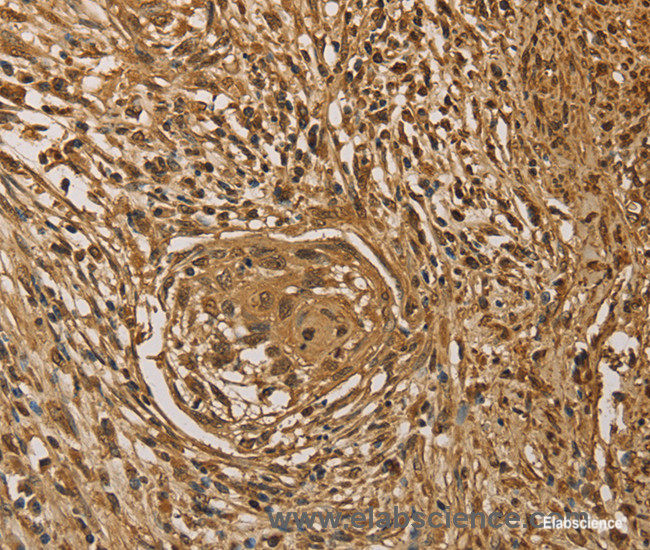 Immunohistochemistry of paraffin-embedded Human cervical cancer tissue using PRDM14 Polyclonal Antibody at dilution 1:40