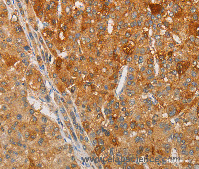 Immunohistochemistry of paraffin-embedded Human liver cancer tissue using ARSG Polyclonal Antibody at dilution 1:30