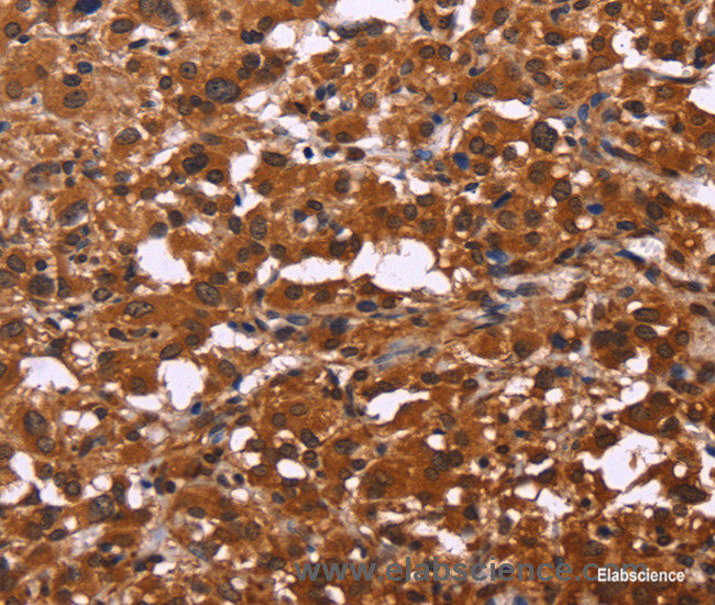 Immunohistochemistry of paraffin-embedded Human thyroid cancer tissue using ART5 Polyclonal Antibody at dilution 1:50