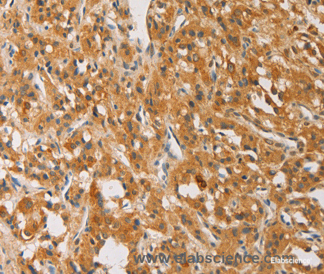 Immunohistochemistry of paraffin-embedded Human thyroid cancer tissue using ATG4D Polyclonal Antibody at dilution 1:40