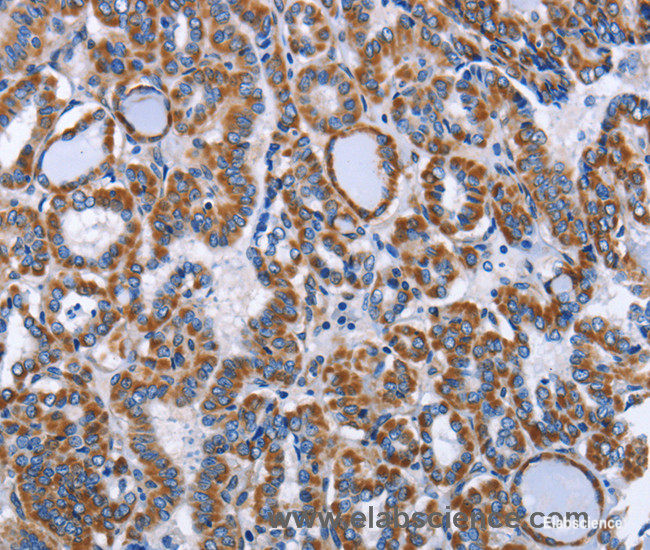 Immunohistochemistry of paraffin-embedded Human thyroid cancer tissue using INTS10 Polyclonal Antibody at dilution 1:50