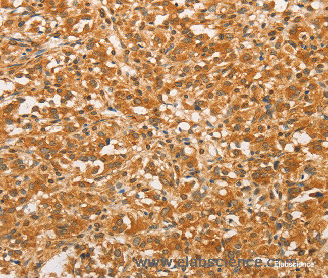 Immunohistochemistry of paraffin-embedded Human thyroid cancer tissue using BCL2L14 Polyclonal Antibody at dilution 1:40