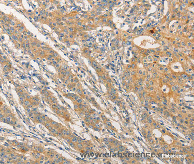 Immunohistochemistry of paraffin-embedded Human gasrtic cancer tissue using STAM Polyclonal Antibody at dilution 1:40
