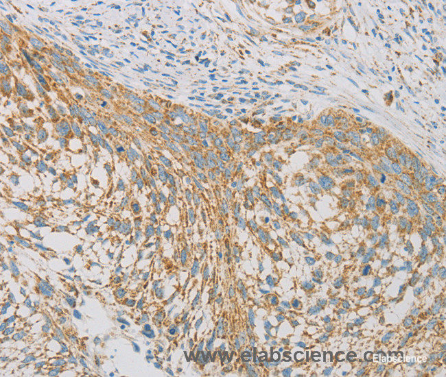 Immunohistochemistry of paraffin-embedded Human cervical cancer tissue using REN Polyclonal Antibody at dilution 1:40