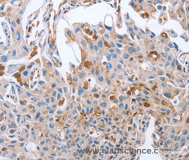 Immunohistochemistry of paraffin-embedded Human lung cancer tissue using NRG4 Polyclonal Antibody at dilution 1:60