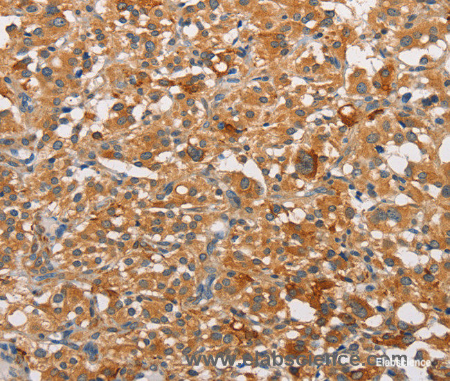 Immunohistochemistry of paraffin-embedded Human thyroid cancer tissue using PKC epsilon Polyclonal Antibody at dilution 1:30