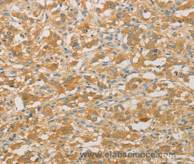 Immunohistochemistry of paraffin-embedded Human thyroid cancer tissue using PRPSAP1 Polyclonal Antibody at dilution 1:50
