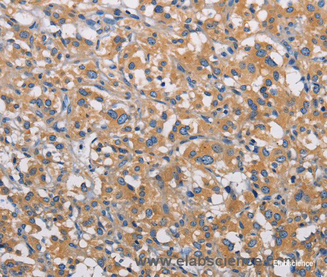 Immunohistochemistry of paraffin-embedded Human thyroid cancer tissue using PIKFYVE Polyclonal Antibody at dilution 1:30