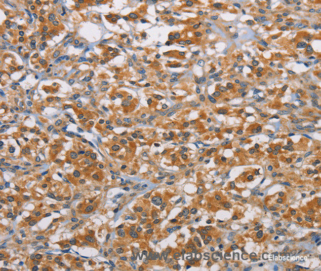 Immunohistochemistry of paraffin-embedded Human thyroid cancer tissue using RICTOR Polyclonal Antibody at dilution 1:40