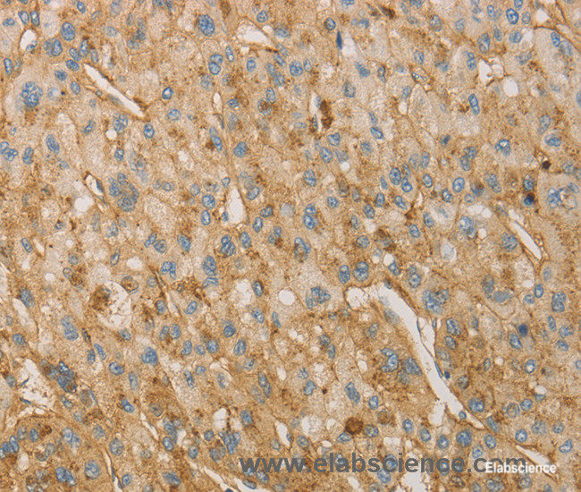 Immunohistochemistry of paraffin-embedded Human liver cancer tissue using VTN Polyclonal Antibody at dilution 1:40