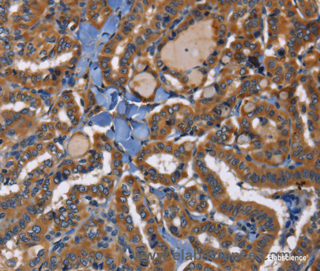 Immunohistochemistry of paraffin-embedded Human thyroid cancer tissue using EPHB6 Polyclonal Antibody at dilution 1:40