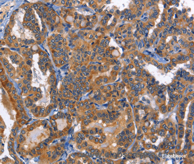 Immunohistochemistry of paraffin-embedded Human thyroid cancer tissue using MUSK Polyclonal Antibody at dilution of 1:40