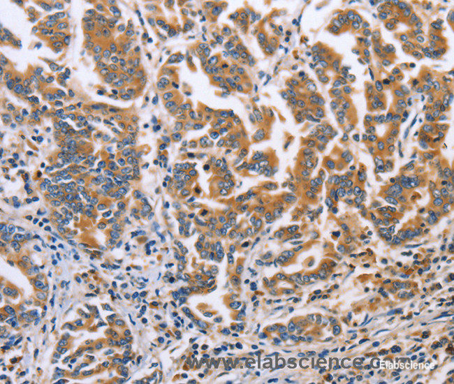 Immunohistochemistry of paraffin-embedded Human gasrtic cancer tissue using DOK4 Polyclonal Antibody at dilution 1:60