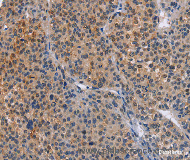 Immunohistochemistry of paraffin-embedded Human liver cancer tissue using MAP3K13 Polyclonal Antibody at dilution 1:40