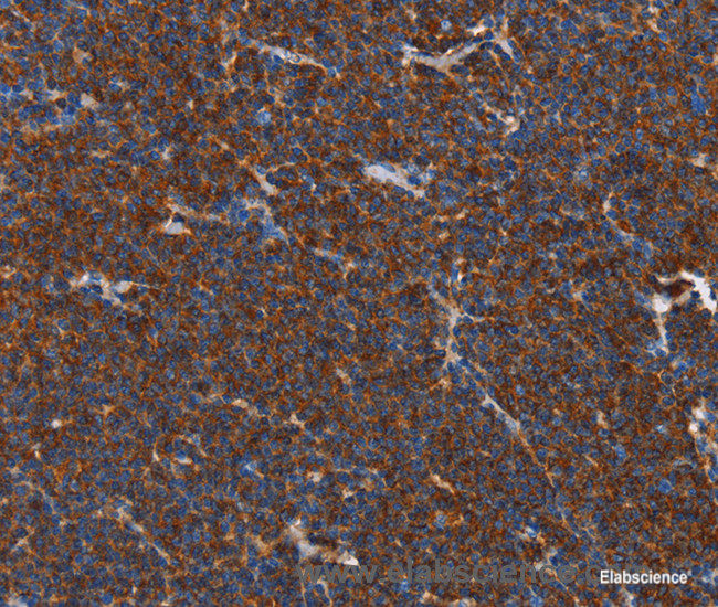 Immunohistochemistry of paraffin-embedded Human lymphoma tissue using FNK Polyclonal Antibody at dilution 1:40