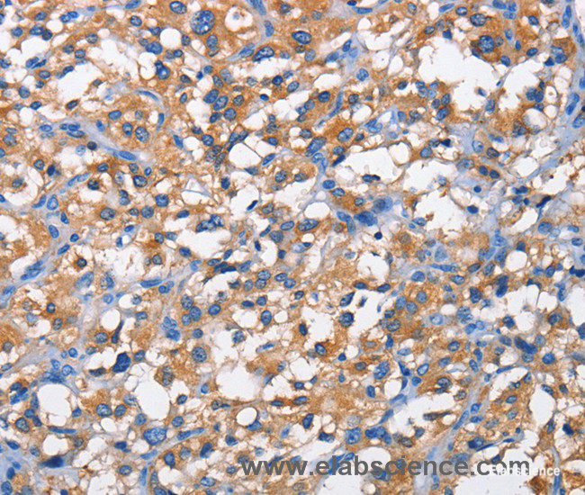 Immunohistochemistry of paraffin-embedded Human thyroid cancer tissue using PFKP Polyclonal Antibody at dilution 1:50