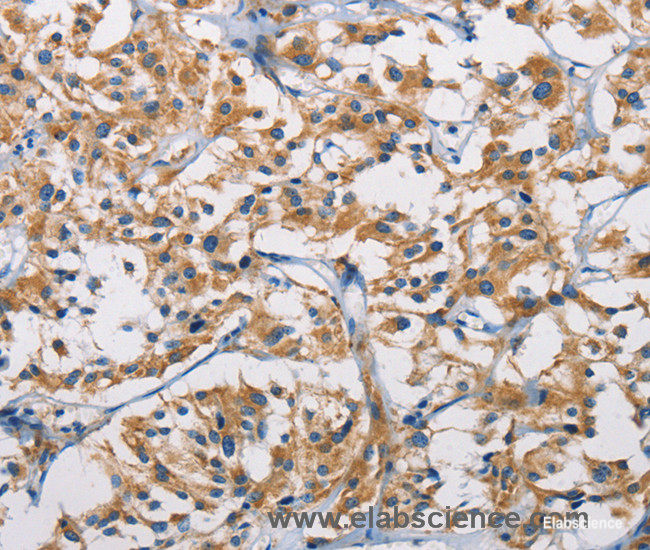 Immunohistochemistry of paraffin-embedded Human thyroid cancer tissue using HK1 Polyclonal Antibody at dilution 1:50