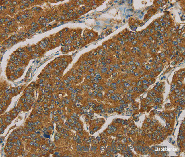 Immunohistochemistry of paraffin-embedded Human breast cancer tissue using NPPB Polyclonal Antibody at dilution 1:30