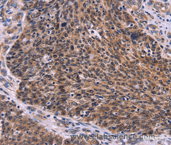 Immunohistochemistry of paraffin-embedded Human ovarian cancer tissue using CDC5L Polyclonal Antibody at dilution 1:30