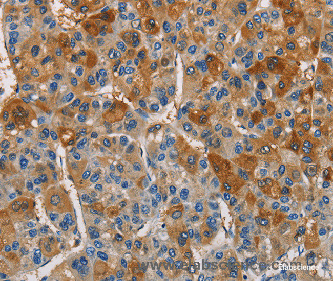 Immunohistochemistry of paraffin-embedded Human liver cancer tissue using CST4 Polyclonal Antibody at dilution 1:60