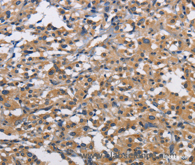 Immunohistochemistry of paraffin-embedded Human thyroid cancer tissue using CBY1 Polyclonal Antibody at dilution 1:60