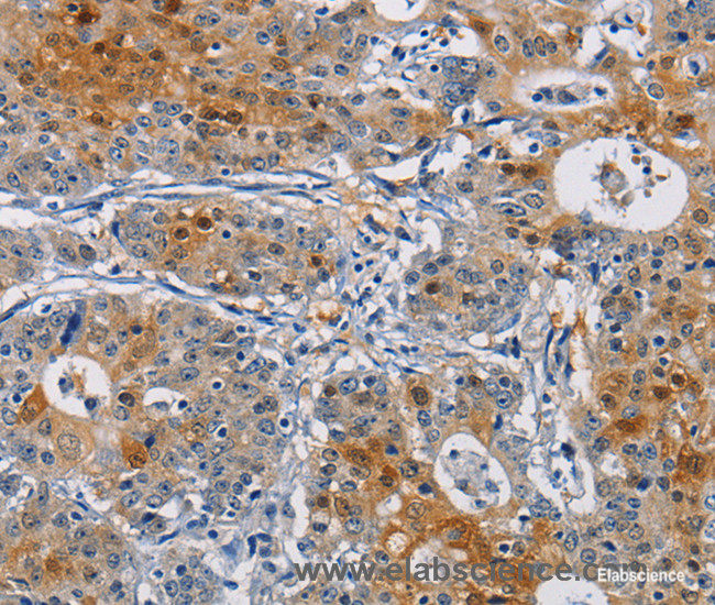 Immunohistochemistry of paraffin-embedded Human gastric cancer tissue using GSTA2 Polyclonal Antibody at dilution 1:50