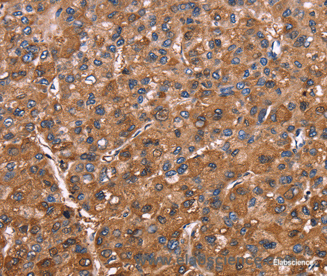 Immunohistochemistry of paraffin-embedded Human liver cancer tissue using ELP2 Polyclonal Antibody at dilution 1:40