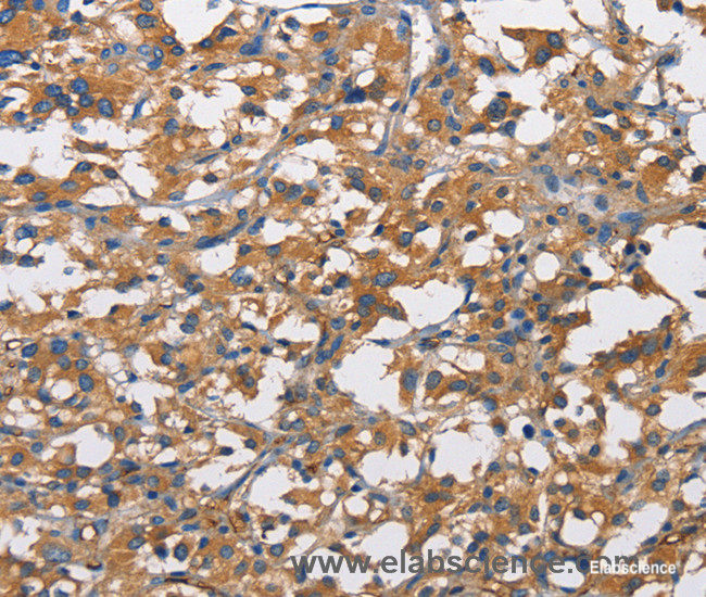 Immunohistochemistry of paraffin-embedded Human thyroid cancer tissue using CD73 Polyclonal Antibody at dilution 1:50