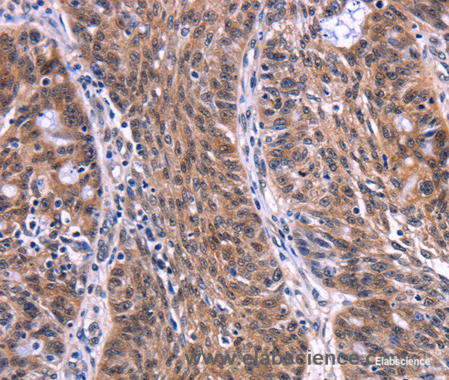 Immunohistochemistry of paraffin-embedded Human ovarian cancer tissue using EIF2AK4 Polyclonal Antibody at dilution 1:50