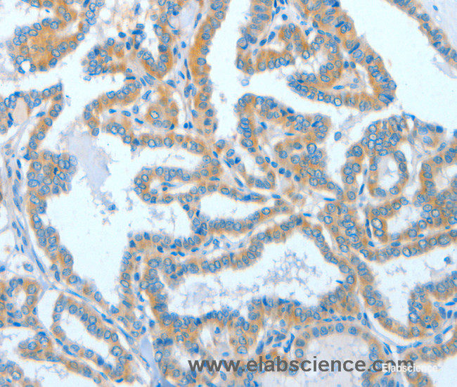 Immunohistochemistry of paraffin-embedded Human thyroid cancer tissue using ASCC1 Polyclonal Antibody at dilution 1:50