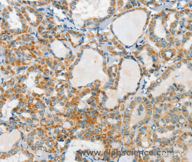 Immunohistochemistry of paraffin-embedded Human thyroid cancer tissue using AANAT Polyclonal Antibody at dilution 1:40