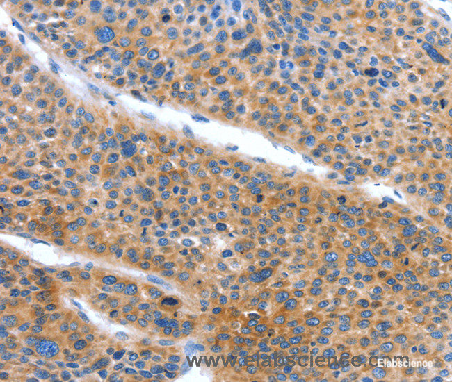 Immunohistochemistry of paraffin-embedded Human liver cancer tissue using ARL11 Polyclonal Antibody at dilution 1:50