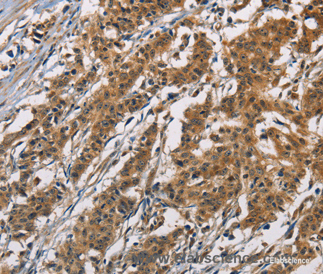 Immunohistochemistry of paraffin-embedded Human gasrtic cancer tissue using ATP2C1 Polyclonal Antibody at dilution 1:60