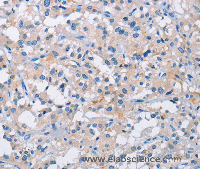 Immunohistochemistry of paraffin-embedded Human thyroid cancer tissue using ATP6AP2 Polyclonal Antibody at dilution 1:50