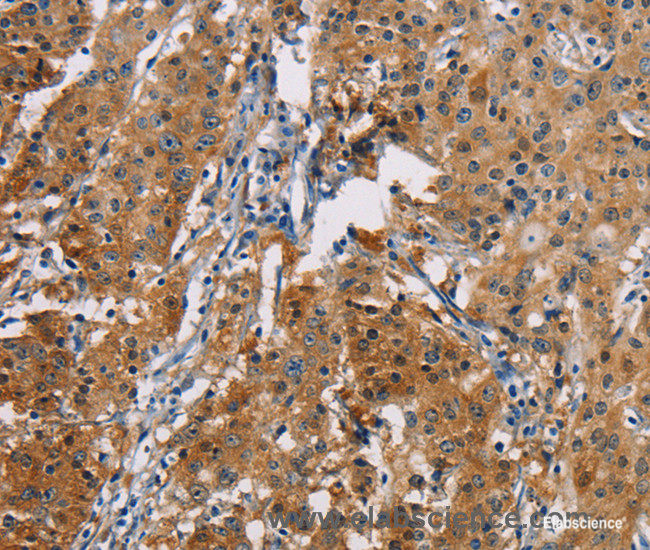 Immunohistochemistry of paraffin-embedded Human gastric cancer tissue using PDCD1LG2 Polyclonal Antibody at dilution 1:50