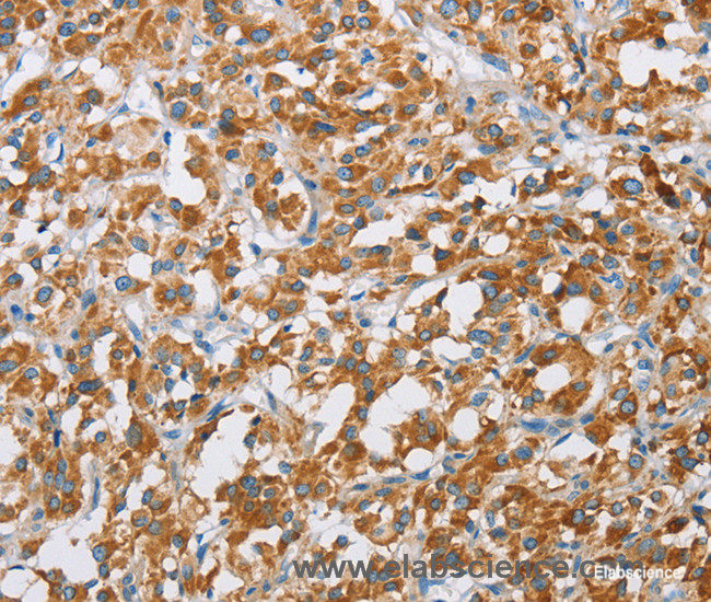 Immunohistochemistry of paraffin-embedded Human thyroid cancer tissue using BDH1 Polyclonal Antibody at dilution 1:60