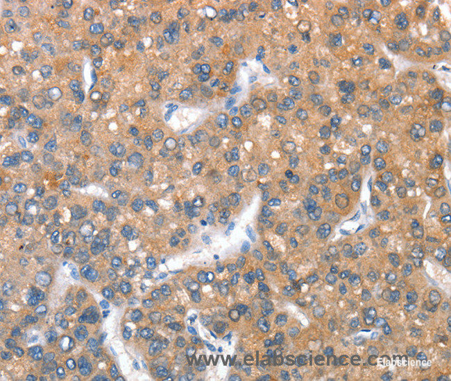 Immunohistochemistry of paraffin-embedded Human liver cancer tissue using CD238 Polyclonal Antibody at dilution 1:40